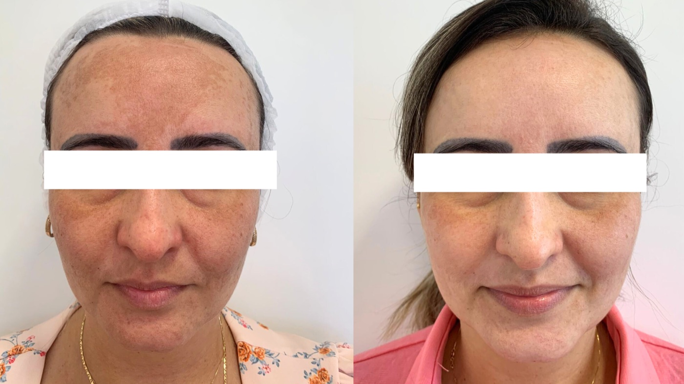 Paciente 1 — melasma no rosto antes e depois do tratamento, vista frontal
