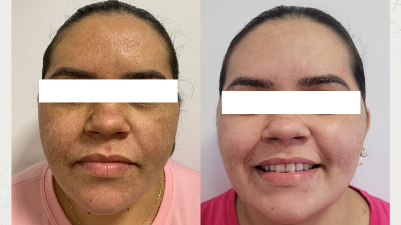 Paciente 2 — melasma no rosto antes e depois do tratamento, vista frontal