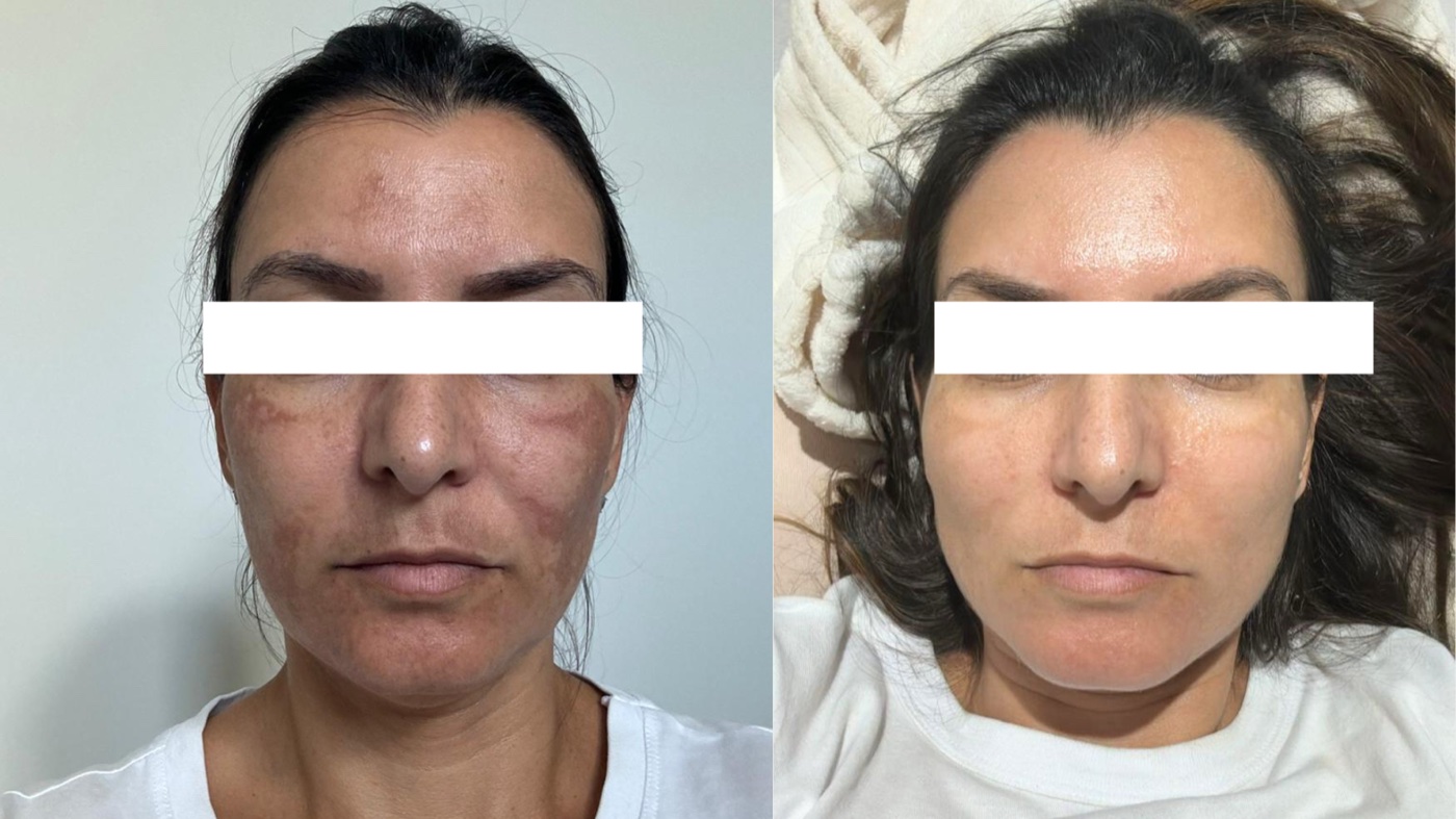 Paciente 3 — melasma no rosto antes e depois do tratamento, vista frontal
