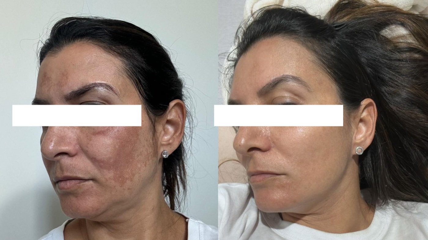 Paciente 3 — melasma no rosto antes e depois do tratamento, vista de perfil