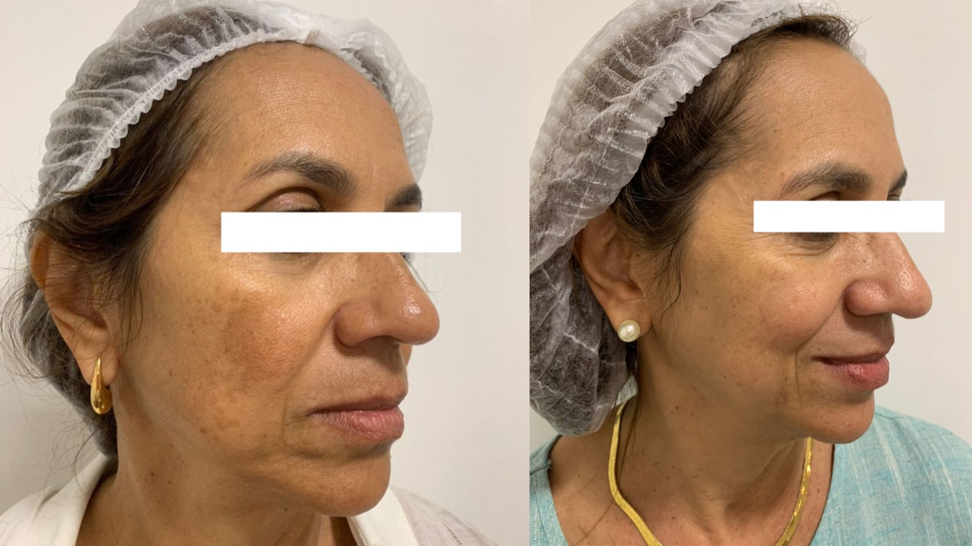 Paciente 4 — melasma no rosto antes e depois do tratamento, vista de perfil