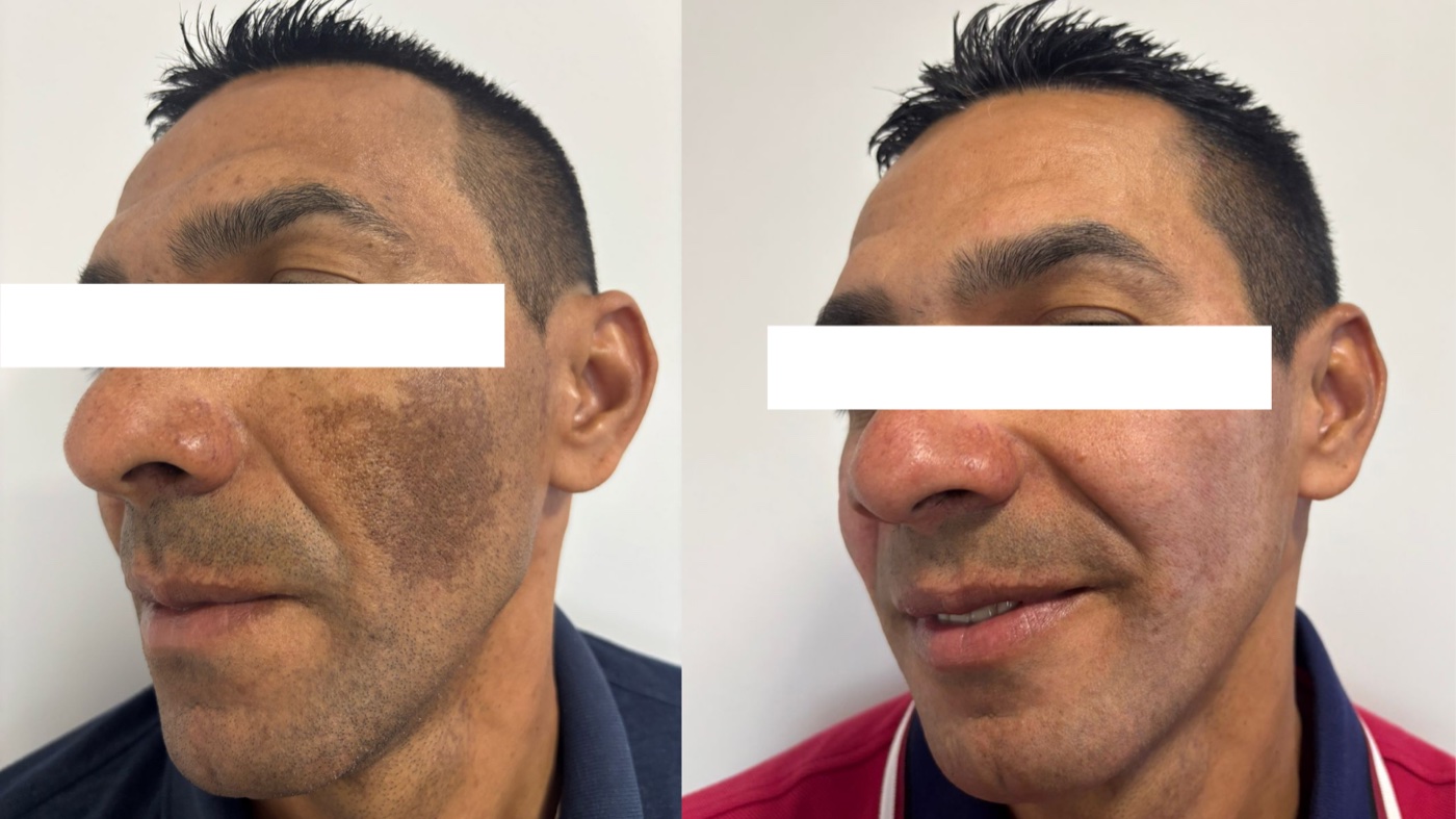 Paciente 5 — melasma no rosto antes e depois do tratamento, vista de perfil